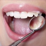A fogak képesek az öngyógyításra – Így előzhető meg a gyökérkezelés